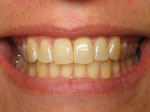 Tooth Whitening Before